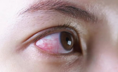 眼睛红血丝怎么办,实用护理与改善方法